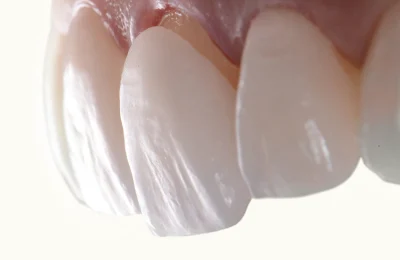 The Surface Prep Required For A Porcelain Smile