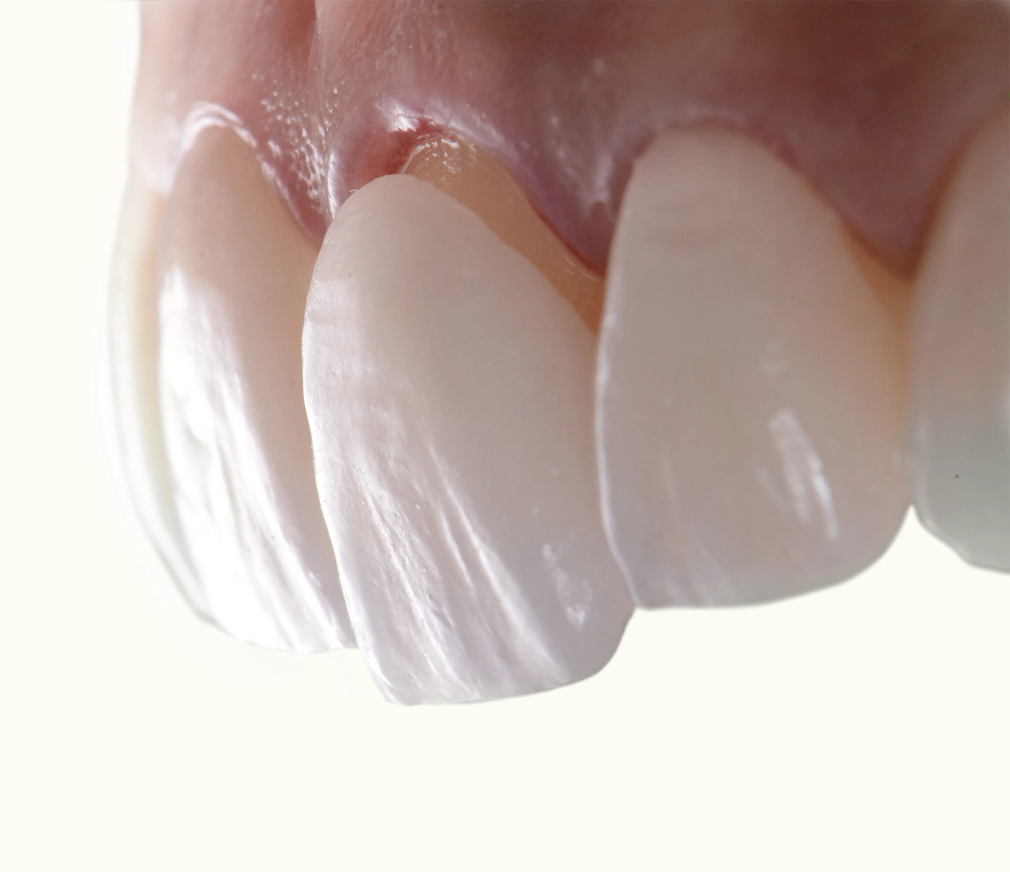 The Surface Prep Required For A Porcelain Smile